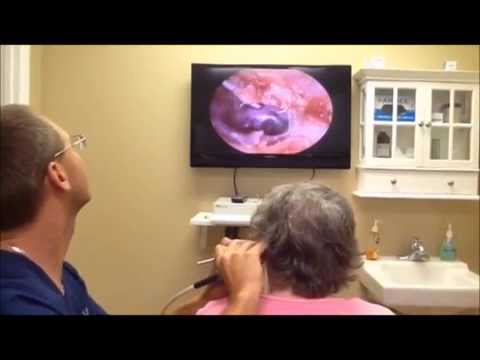 Demonstration of Audiologist removing ear wax to help hearing aid performance.